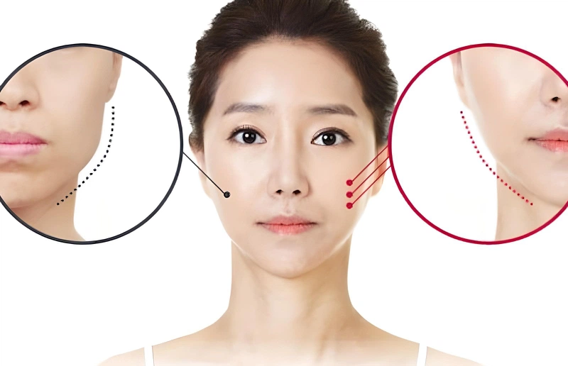Gọt hàm vuông giúp điều chỉnh đường nét góc hàm