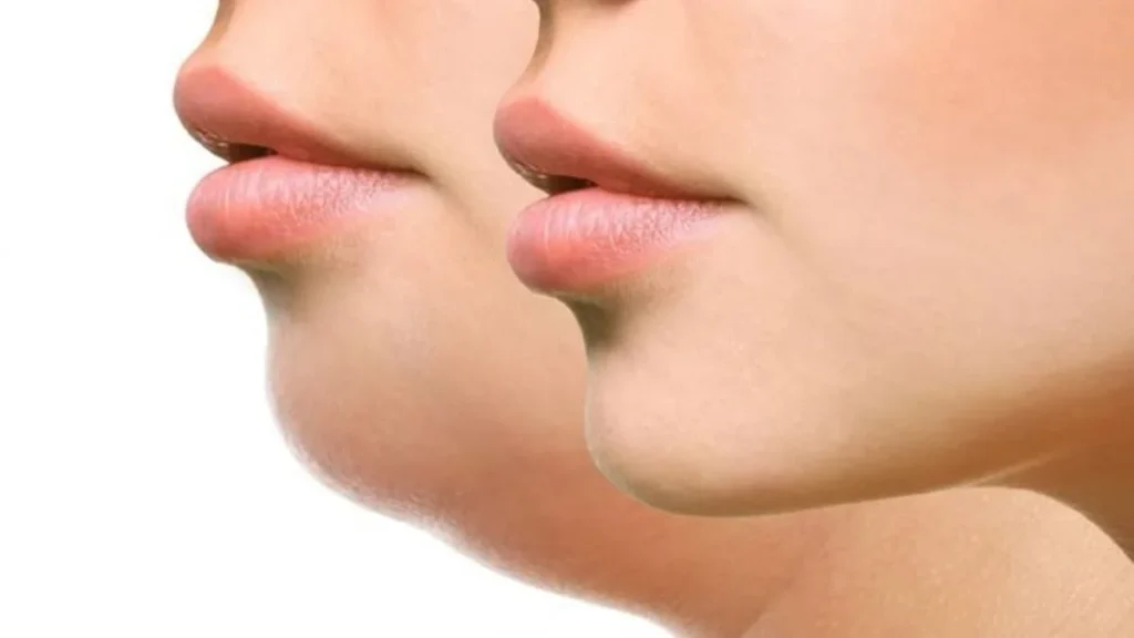Trượt cằm là phương pháp phẫu thuật tạo hình xương cằm