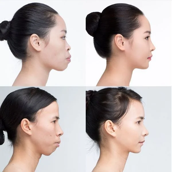 Đặc điểm cằm lẹm và thiếu độ nhô khi nhìn nghiêng