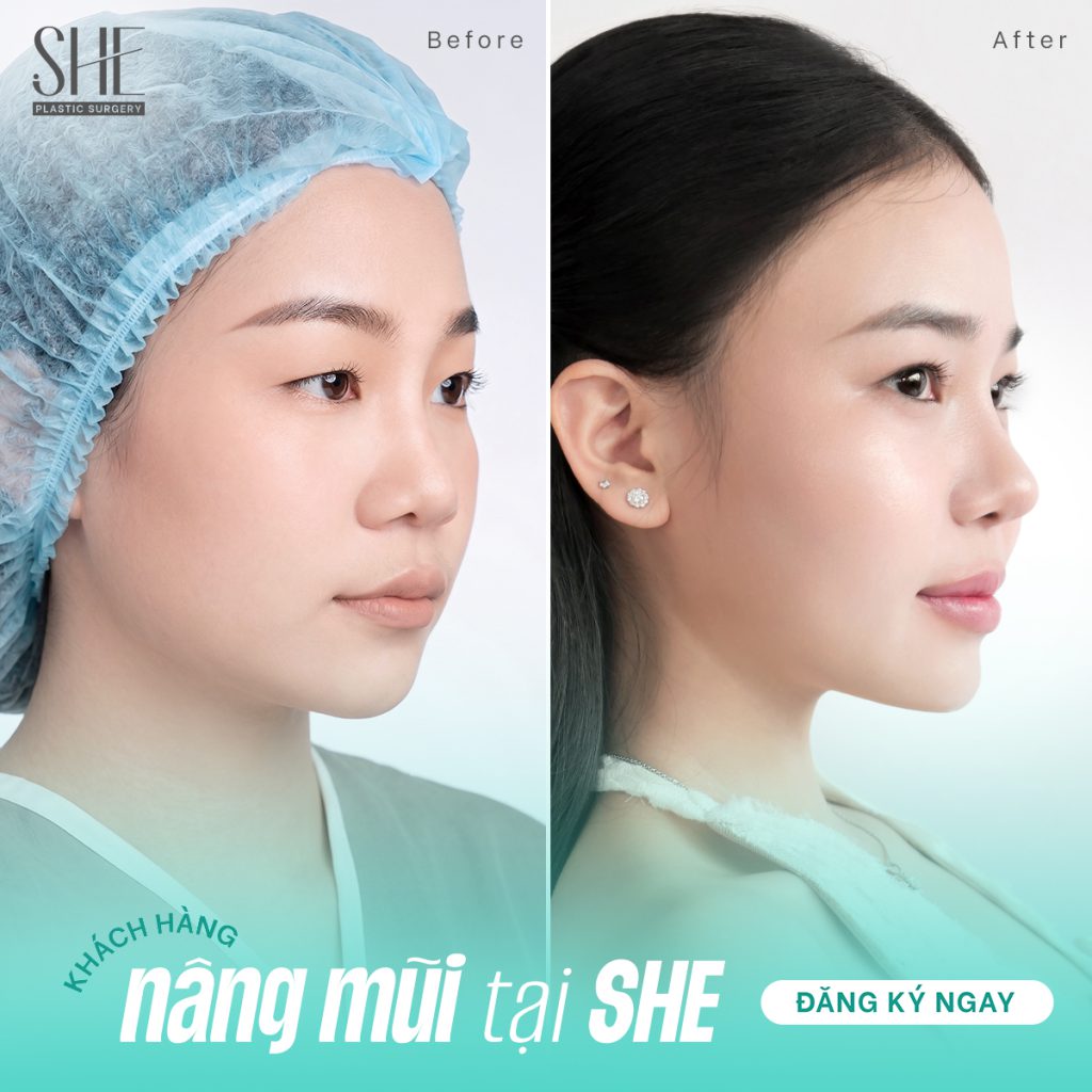 Hình ảnh khách hàng nâng mũi thành công tại SHE