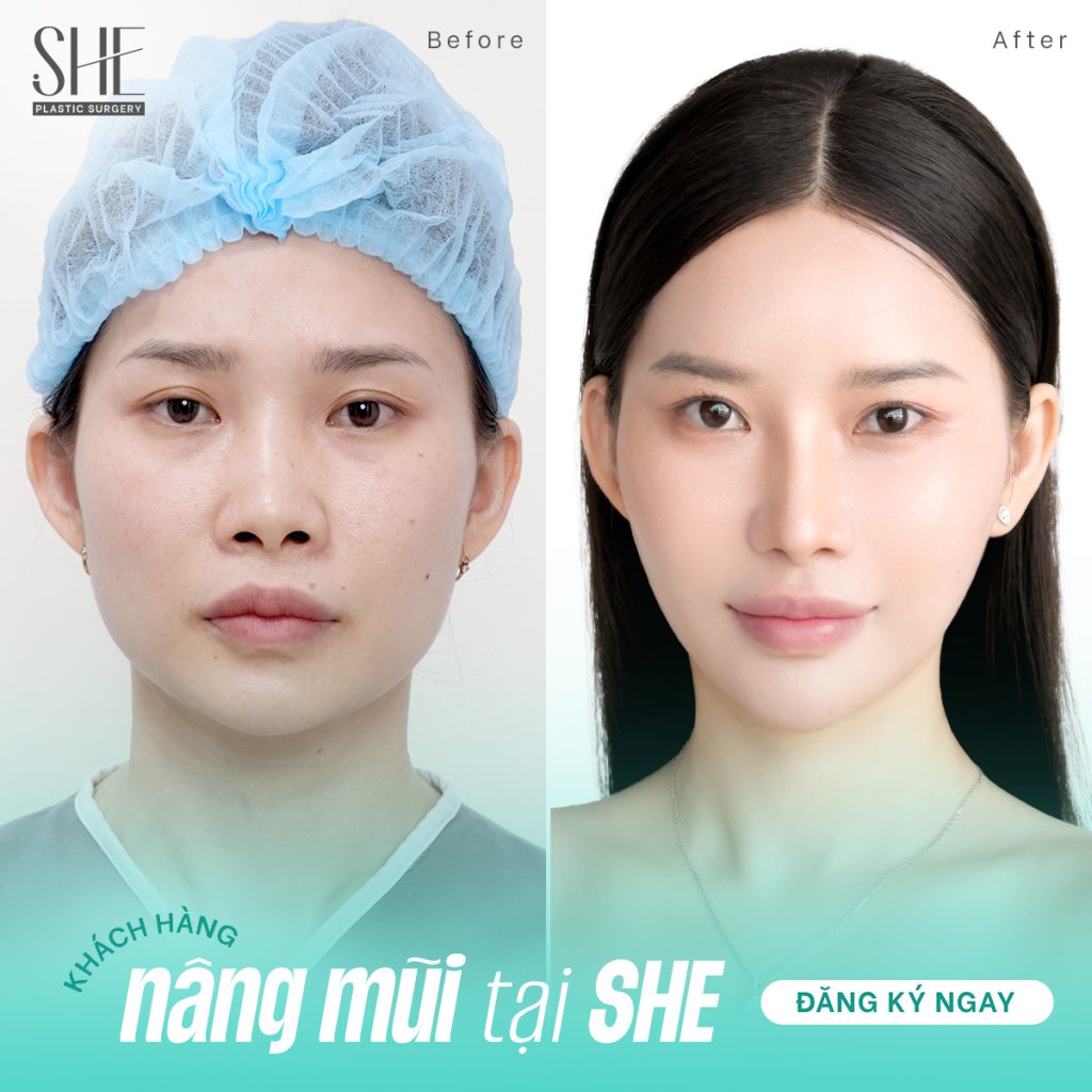 Hình ảnh khách hàng nâng mũi thành công tại SHE