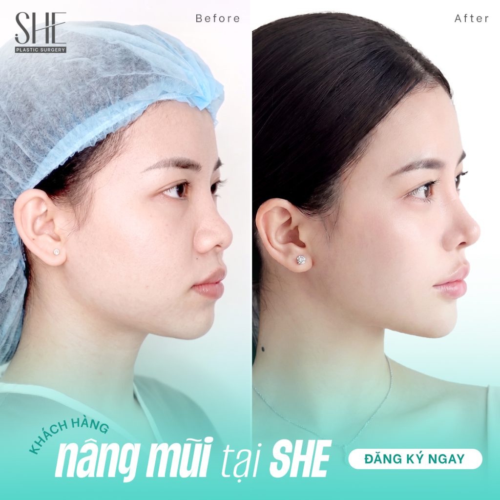 Hình ảnh khách hàng nâng mũi thành công tại SHE