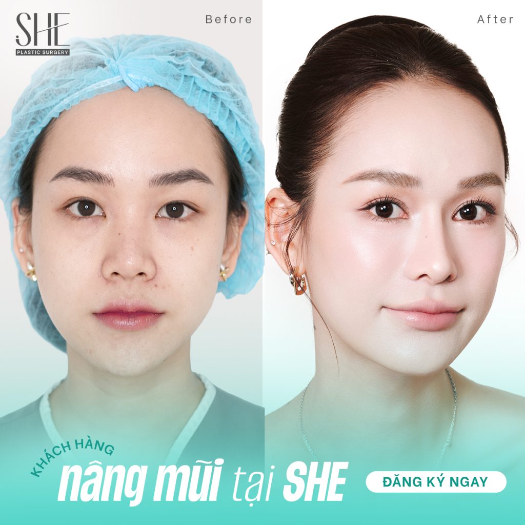 Hình ảnh khách hàng nâng mũi thành công tại SHE