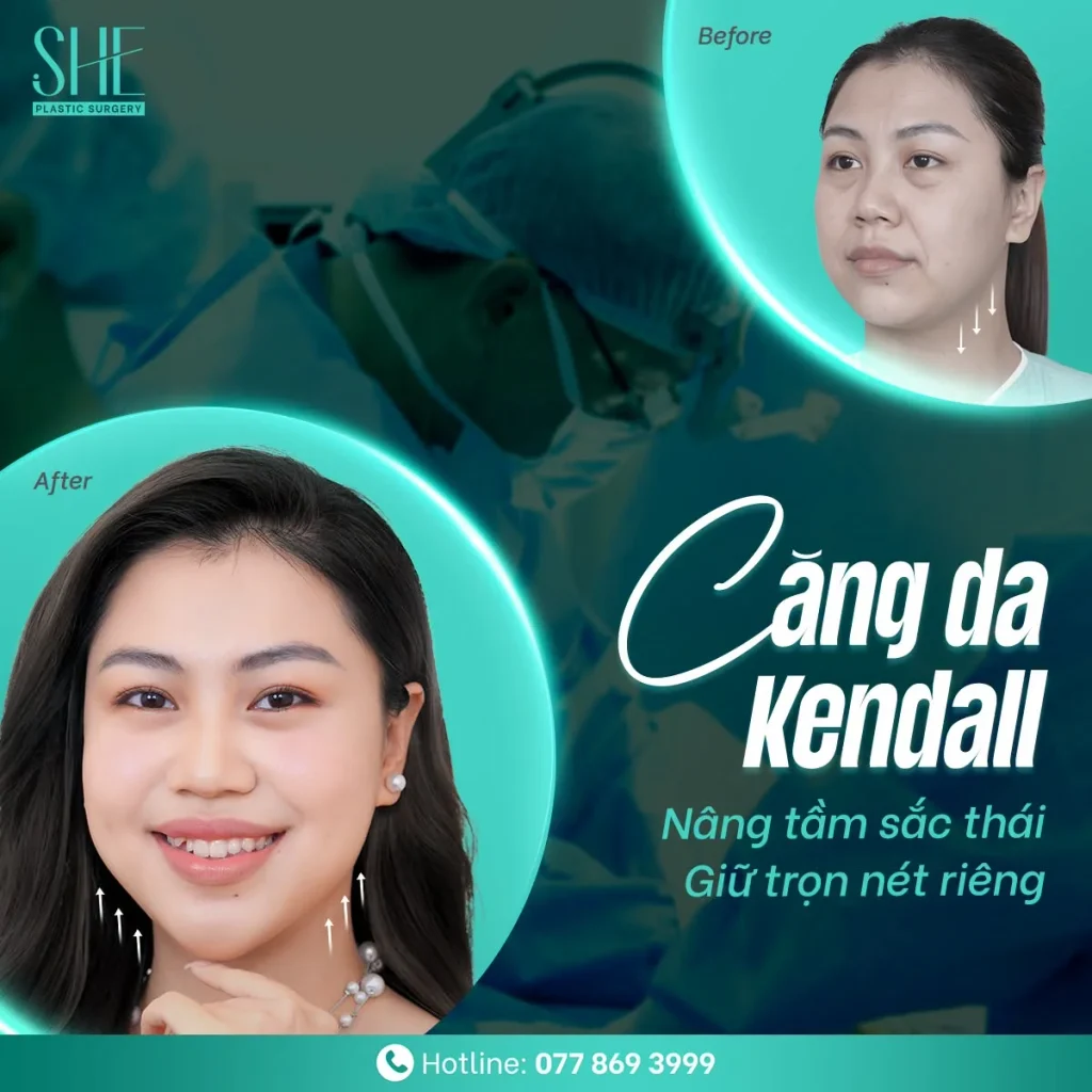 Căng da Kendall