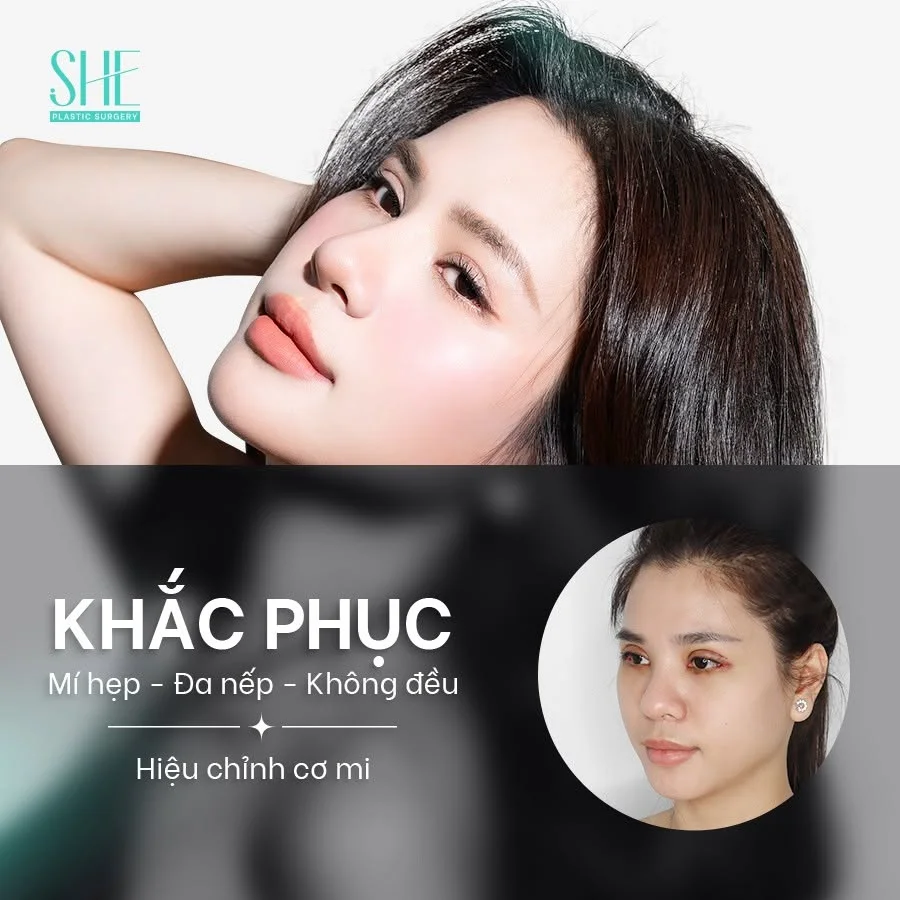 Quá trình hồi phục sau cắt mắt hoặc tạo hình mí không giống nhau ở tất cả khách hàng