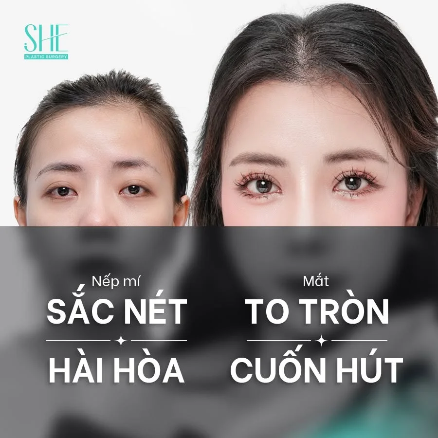 Mức độ cải thiện sẽ phụ thuộc vào cấu trúc mắt và phương án bác sĩ lựa chọn