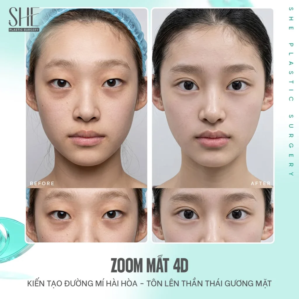 Zoom Mắt 4D có thể được cân nhắc cho những khách hàng đang gặp nhiều vấn đề
