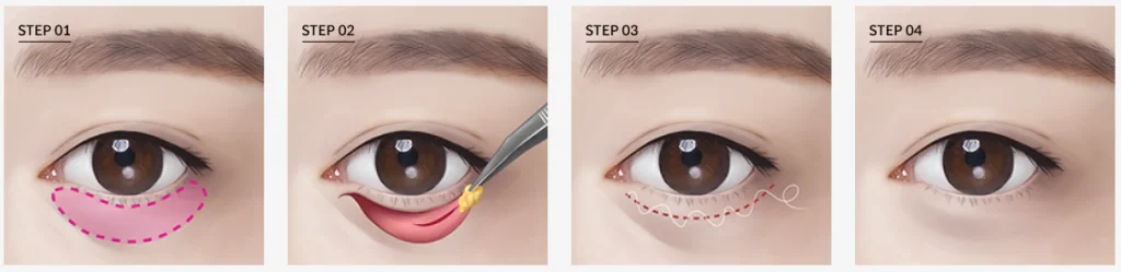 Cắt mí dưới cải thiện bọng mỡ và da dư vùng mắt