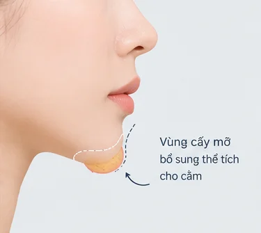 Mô phỏng vùng cằm cần bổ sung thể tích bằng phương pháp cấy mỡ.