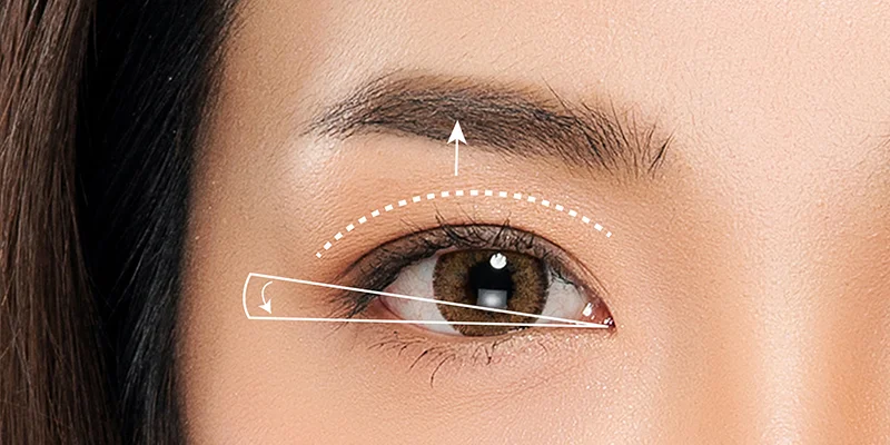 So sánh tạo hình nếp mí và chỉnh cơ nâng mi khi cắt mí