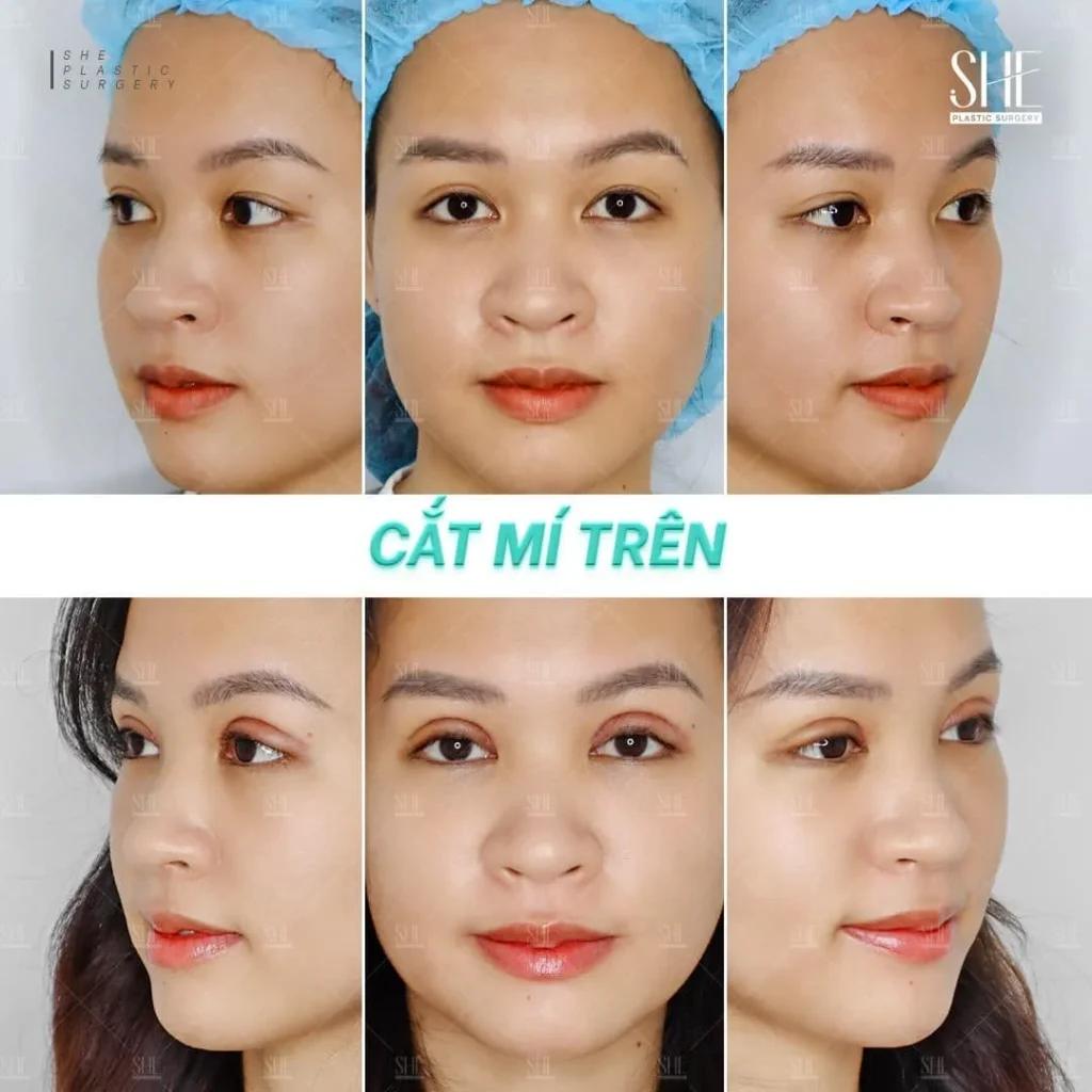 Dịch vụ tư vấn thẩm mỹ mắt tại SHE by SHYNH