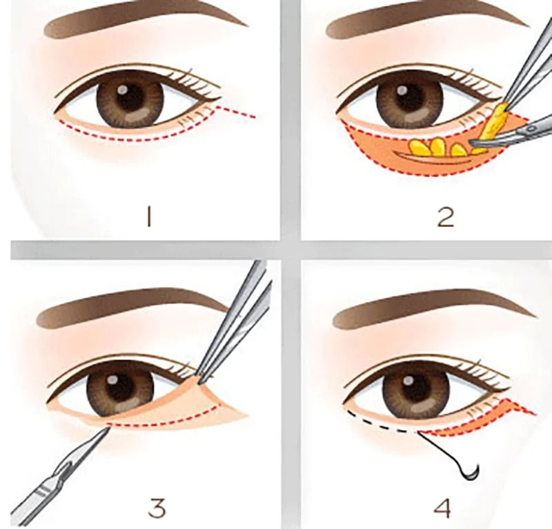 Dàn trải mỡ mí dưới xử lý da dư và mô mỡ theo chỉ định