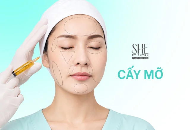 Cấy mỡ