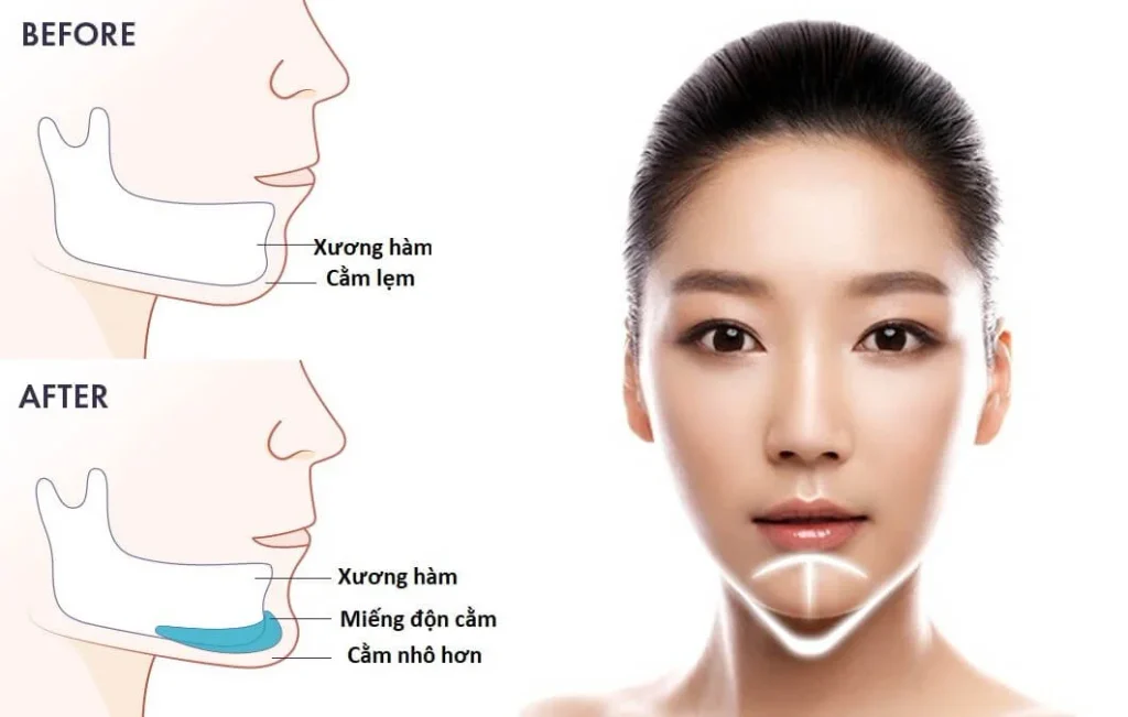Độn cằm Silicon giúp cải thiện dáng cằm và tỷ lệ khuôn mặt