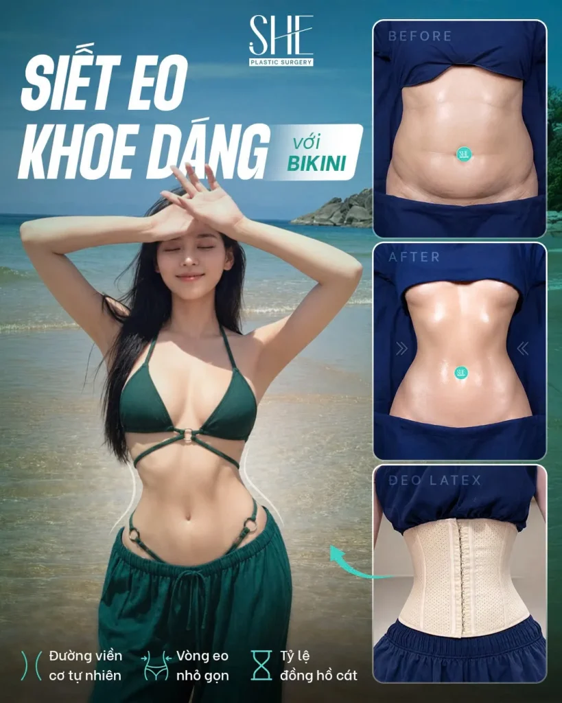 Tình trạng mỡ thừa tích tụ ở bụng trên và bụng dưới khiến vòng eo kém gọn gàng.