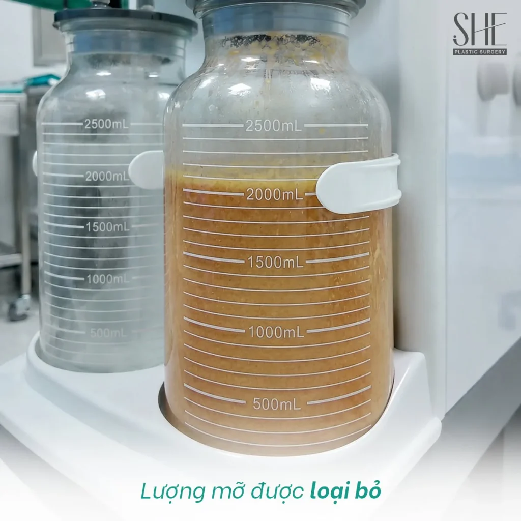 Bác sĩ thực hiện hút mỡ bắp chân theo chỉ định chuyên môn