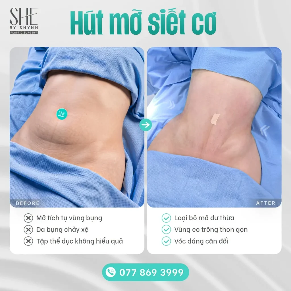 Tình trạng da bụng chùng và cơ thành bụng giãn sau sinh hoặc thay đổi cân nặng.