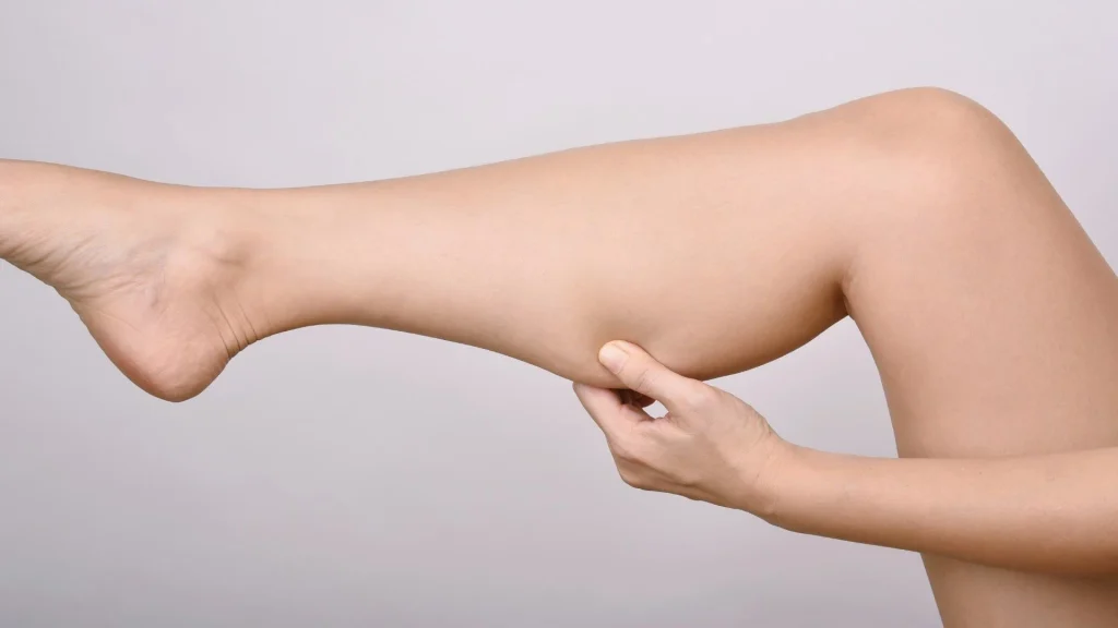 Các trường hợp bắp chân to do tích tụ mô mỡ