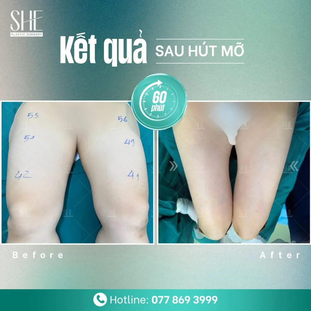 Hút mỡ toàn đùi dành cho người có mỡ thừa khu trú ở vùng đùi