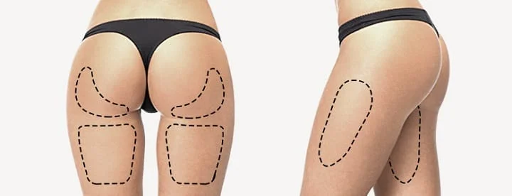 Các vùng đùi có thể được cân nhắc khi thực hiện hút mỡ đùi