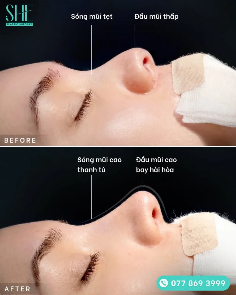 Cấu trúc sống mũi và đầu mũi trong phương pháp nâng mũi bán cấu trúc