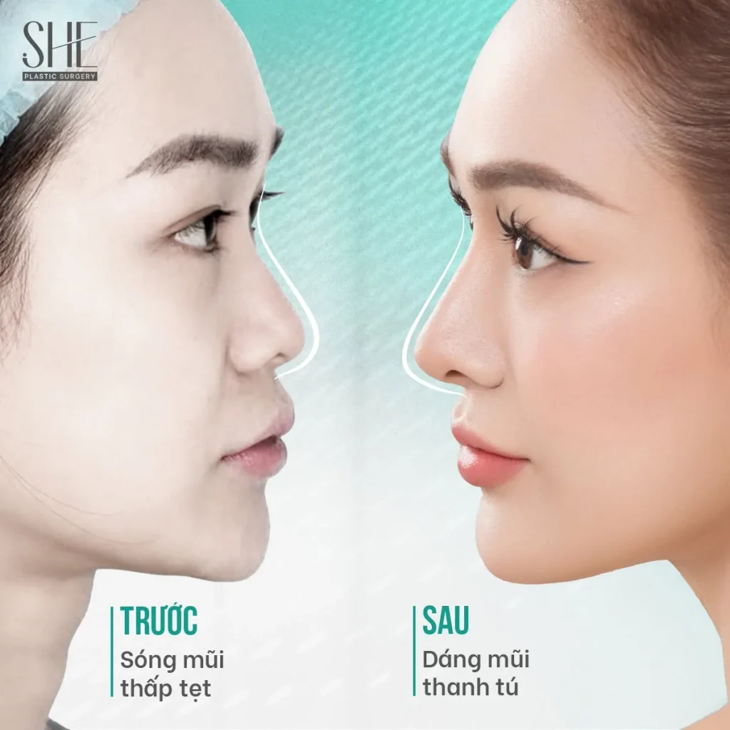 Nâng mũi bán cấu trúc bằng PTFE Surgiform tại SHE by SHYNH