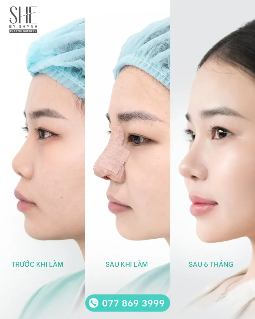 Nâng mũi cấu trúc PTFE Surgiform tại SHE by SHYNH